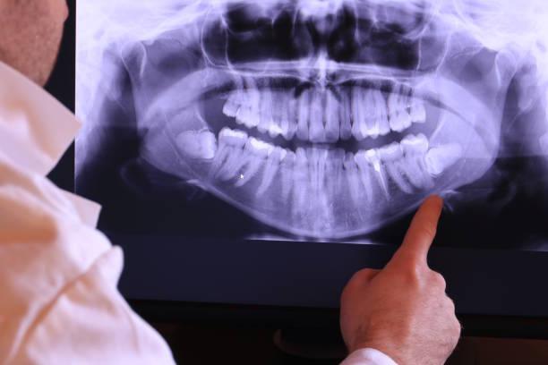 Best Emergency Wisdom Teeth Removal in Harleysville, PA