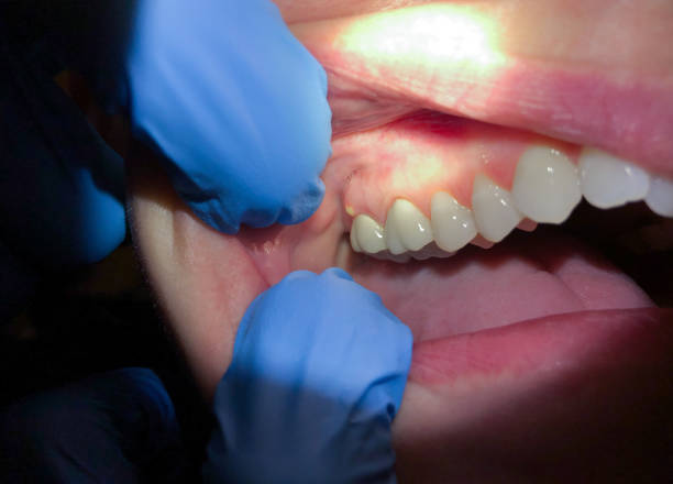Best Emergency Root Canal Treatment in Harleysville, PA